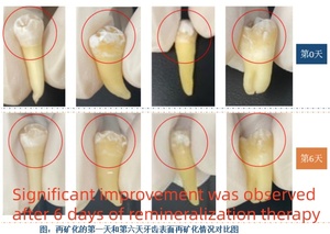 Gel Desensibilizante Dental 4 en 1, Desensibilización, Anticaries, Antibacteriano, Fortalece el Esmalte Dental - Product Image 2