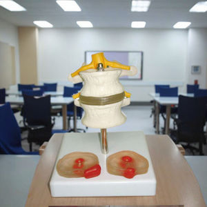 Modèle anatomique de la colonne vertébrale humaine avec deux disques intervertébraux lombaires et deux lésions Matériau en PVC Structure anatomique vive - Product Image 4
