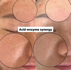 Solución Exfoliante Facial de Seis Ácidos y Tres Enzimas, <span class=keywords><strong>Peeling</strong></span> Químico, Minimizador de Poros, Tratamiento Profesional de Salón - Product Image 3