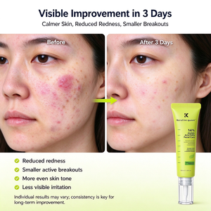 Gel anti-acné réparateur rapide et efficace pour cicatrices d'acné, élimination des taches, réduction des pores, crème visage anti-acné à 14% d'acide azélaïque, vente en gros - Product Image 3