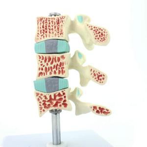 Gelsonlab HSBM-139 Tulang Belakang Model Anatomi, Model Osteoporosis, Ntervertebral Disc Model Perut Ortopedi Nyeri Model - Product Image 2