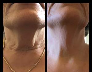 Máquina Portátil de Lipólisis Láser para Lifting Facial y Pérdida de Peso, <span class=keywords><strong>Precio</strong></span> de Fábrica, Mínimamente Invasiva, 47w, 980nm, 1470nm, Diodo, Endo Face Lift - Product Image 4