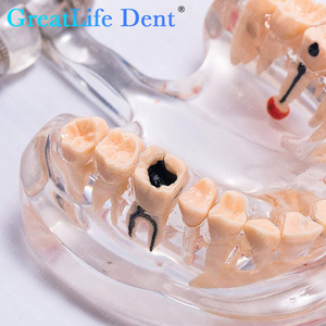Modelo de Estudio de Patología Dental Greatlife Dent XVD2530 con Certificación CE Clase I, Implante Dental de 32 Dientes, Diseño Transparente - Product Image 6