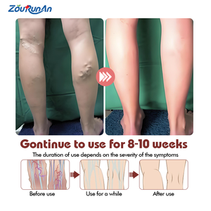 Ungüento para venas varicosas, venas, dolor, vasculitis, flebitis, pierna de araña, cuidado de la salud, crema de hierbas, alivia el dolor de piernas, suavizante - Product Image 5