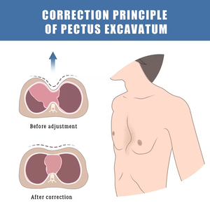 Orthèse pour Pectus Excavatum, soutien pour <span class=keywords><strong>la</strong></span> déformité sternale et <span class=keywords><strong>la</strong></span> dépression sternale, pour tous les enfants et adultes - Product Image 5