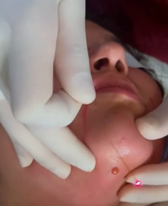 ポータブル医療用エンドーザーフェイスリフティングおよびスリミングマシン980/1470ダイオードレーザー脂肪分解非外科用脂肪吸引 - Product Image 6