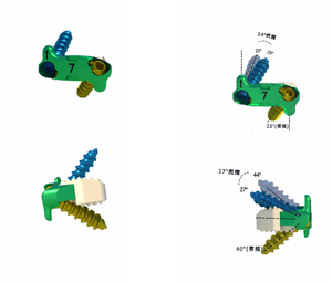 Orthopedische Chirurgische Implantaten <span class=keywords><strong>Titanium</strong></span> Fedex Aangepast Nulprofiel Anterieure Cervicale Kooi Instrumenten Klasse Iii Ce Gecertificeerd - Product Image 3