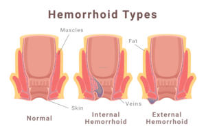 Proctología Láser médico Urología 980 1470nm Proctología Diodo Láser Hemorroides Anal Fístula Pilas Cirugía 600um Fibra cónica - Product Image 2
