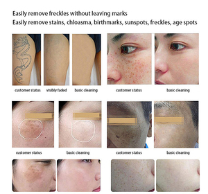 Appareil Pico Yag pour l'épilation complète du corps, l'élimination des pigments, le raffermissement de la peau, le blanchiment et l'élimination des tatouages, pour usage esthétique - Product Image 6