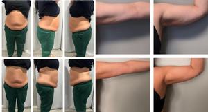 Trusculpt Flex 6/8 bebas genggam Taut Lipolaser 650nm 635nm lampu merah pembakar lemak Ems tesla terapi vakum <span class=keywords><strong>Rf</strong></span> mesin kontur tubuh - Product Image 5