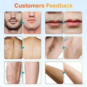 Appareil de gestion des poils à triple longueur d'onde pour une peau lisse, épilation indolore, équipement de salon - Product Image 6