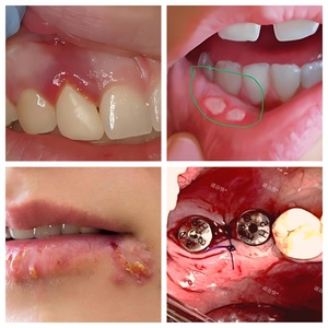 Esunix - Antiséptico Oral Específico para Periodoncia, Bacteriostático, Antibacteriano, en Tubos/Caja de <span class=keywords><strong>Gel</strong></span> Plástico, Tratamiento para Implantes Dentales - Product Image 4