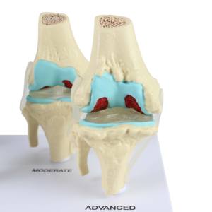 Modèle d'articulation du genou, anatomie humaine, modèle de genou pour l'enseignement de la pathologie, 4 étapes - Product Image 5