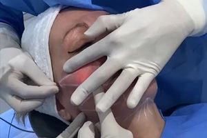 Machine de liposuccion Vaser Laser à diode à double onde 980nm1470nm Lipolyse raffermissant la peau Endolaser Lifting du visage - Product Image 6