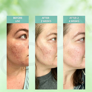 Sérum facial à l'acide azélaïque Oalen Private Label, hydratant, soin des imperfections, réduit les rougeurs de la <span class=keywords><strong>peau</strong></span>, adapté aux peaux sensibles et grasses - Product Image 6