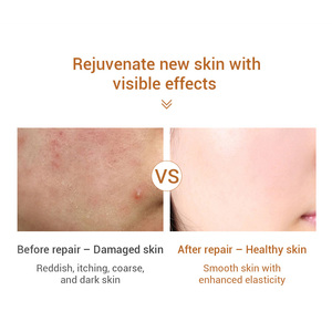Crème visage réparatrice anti-allergique et apaisante pour peaux sensibles, blanchissante, marque privée LANBENA, à l'ectoïne - Product Image 5