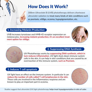 Equipo <span class=keywords><strong>de</strong></span> Terapia <span class=keywords><strong>de</strong></span> Luz Excimer UVB <span class=keywords><strong>de</strong></span> 308nm Ajustable y Dirigido <span class=keywords><strong>para</strong></span> Vitiligo Localizado, Vitiligo en <span class=keywords><strong>el</strong></span> Cuello, Psoriasis y Eccema en las <span class=keywords><strong>Manos</strong></span> - Product Image 2