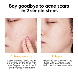 Gel Reparador Rápido y Efectivo para Cicatrices de Acné, Elimina Manchas, Suaviza la Piel, Reduce los Poros, Crema de Tratamiento para el Acné con Ácido Salicílico - Product Image 2