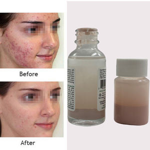 เซรั่ม<span class=keywords><strong>รักษา</strong></span>สิวสูตรทำความสะอาดล้ำลึก แบรนด์ส่วนตัว ผสมซิงค์และเบนโซอิลเพอร์ออกไซด์ ครีม<span class=keywords><strong>รักษา</strong></span>สิวสูตรอ่อนโยน กำจัดแบคทีเรีย ลดรอยสิว - Product Image 1