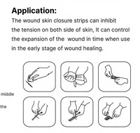 Kit de Fermeture de Plaies en Bandes Stérilisé à l'OE à Usage Unique pour Soins Chirurgicaux Réparation Rapide des Lacerations