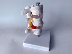 Model herniasi Lumbar manusia kolom tulang belakang vertebra dapat dilepas untuk chiropractor 3 Model vertebra - Product Image 6