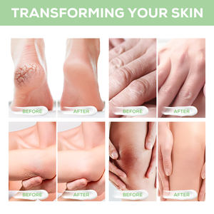 Krim Perawatan Kulit YECUCE 40% Urea untuk Tumit, Lutut, Siku, Tangan, dan Kaki yang Kering dan Pecah-pecah, Penghilang Kulit Mati dan Kapalan dengan Asam Salisilat - Product Image 4