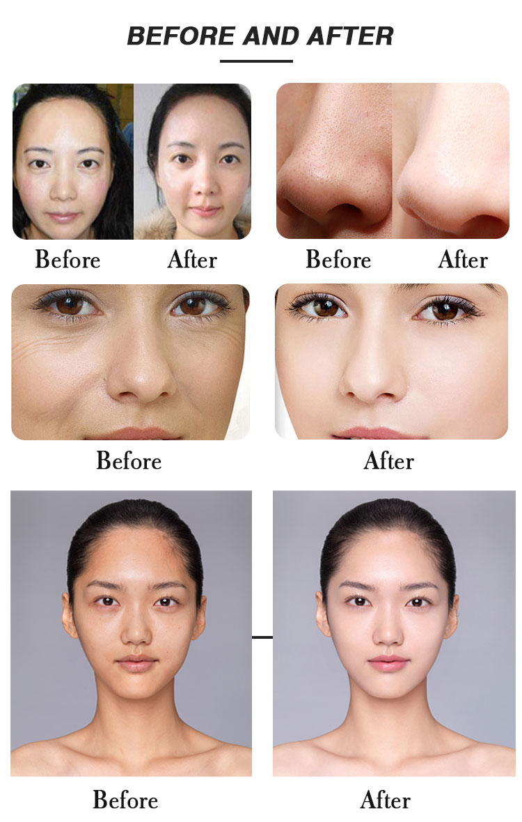 Good Quality Ems Tightening Machine Face Lifting Device Wrinkle Remover Skin