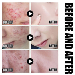 Sérum de soin de la peau 100% naturel à étiquette privée en gros, sérum anti-acné, contrôle de l'huile, éclaircissement des marques d'acné, réparation de la barrière cutanée - Product Image 5