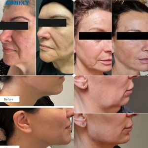 Laser a Diodi Medicale Endolaser 980nm 1470 per Lifting Facciale, Lipolisi, Ablazione Laser Endovenosa e Rimozione di Vene Varicose (2026) - Product Image 5