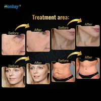 Máquina Digital de Rejuvenecimiento Facial y Moldeado Corporal con 2 Manijas para un Tratamiento de Contorno Preciso y Programas Personalizables