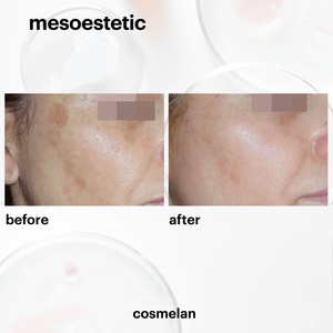 <span class=keywords><strong>Cosmelan</strong></span> <span class=keywords><strong>2</strong></span> de <span class=keywords><strong>Mesoestetic</strong></span>, Paquete de Peeling Clínico Multifuncional para Pigmentación, Cuidado de la Piel, Cuidado Corporal, Gel Íntimo - Product Image 4