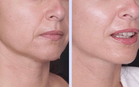Portable 980nm 1470nm Diode Laser Vaser Liposuccion Machine Lipolyse Perte De Poids Endolaser Lifting Du Visage