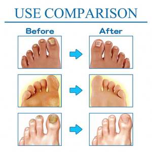 Venta al por mayor Etiqueta Privada 50ML alivio del dolor fórmula natural antihongos antipicazón espray <span class=keywords><strong>para</strong></span> el cuidado <span class=keywords><strong>de</strong></span> los pies del <span class=keywords><strong>atleta</strong></span> - Product Image 5