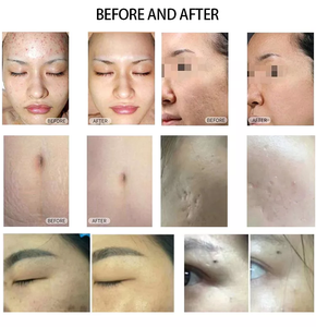 Máquina profesional de rejuvenecimiento vaginal con láser fraccional de CO2 para la eliminación de cicatrices/estrías/marcas en la piel - Product Image 6