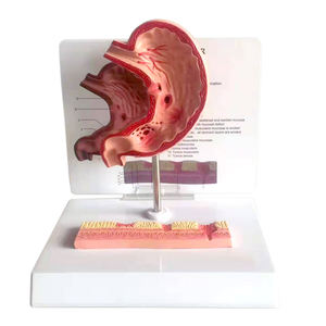Modèle anatomique de l'estomac malade grandeur nature pour l'enseignement médical, modèle de gastrite et d'ulcère - Product Image 1