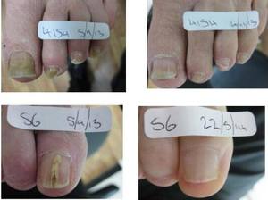 Láser de Diodo de 980nm para <span class=keywords><strong>Hongos</strong></span> en las <span class=keywords><strong>Uñas</strong></span>, Máquina de <span class=keywords><strong>Tratamiento</strong></span> de <span class=keywords><strong>Hongos</strong></span> en las <span class=keywords><strong>Uñas</strong></span> con Láser de Podología - Product Image 6