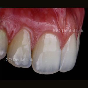 Buen <span class=keywords><strong>Precio</strong></span> Chapa Dientes Restauración <span class=keywords><strong>de</strong></span> porcelana Blanqueamiento dental Preparación mínima Carillas <span class=keywords><strong>dentales</strong></span> - Product Image 5