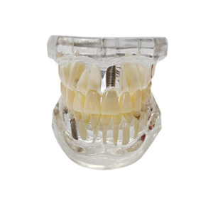 Modèle dentaire transparent de haute qualité, nouveau modèle d'affichage pathologique pour prothèses dentaires et implants - Product Image 1