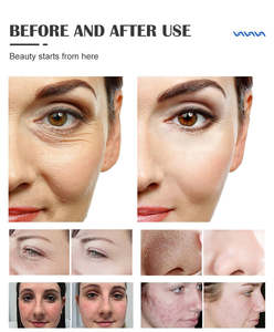 Máquina de Hidrodermoabrasión 17 en 1, Máquina de Belleza Facial, Máquina de Limpieza de Piel con Burbujas Pequeñas para Salón de Belleza - Product Image 5