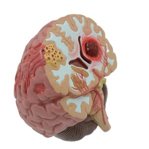 Modèle de <span class=keywords><strong>pathologie</strong></span> du cerveau humain avec hémorragie et malformation <span class=keywords><strong>vasculaire</strong></span> pour l'enseignement de l'anatomie - Product Image 4
