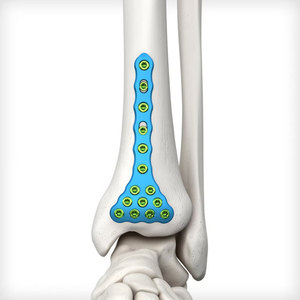 Implantes Ortopédicos de Titanio de Nuevo Diseño en Oferta, Placa para Radio Distal y Únula, Placa Ósea de Ángulo Variable, Implantes Ortopédicos Reutilizables - Product Image 1