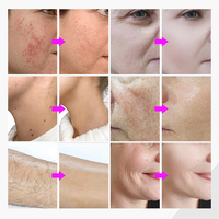 Appareil d'épilation par électrolyse 5 en 1 pour clinique esthétique, homologué CE ROHS, fréquence 36,5 MHz, pour l'élimination des poils gris, blancs et bruns