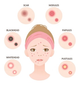 Couverture d'acné de coeur de laser Acné hydrocolloïde absorbant Zits et imperfections Pimple Patch pour le visage - Product Image 5