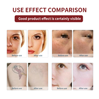 Équipement de pico-laser multifonctionnel pour le traitement esthétique du visage, l'élimination des taches pigmentaires et des tatouages par laser picoseconde