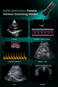 Yonker Wireless Handheld Color <strong>Doppler</strong> <strong>Ultrasound</strong> Scanner Optional AI Function for Bedside Emergency Telemedicine - Product Image 5
