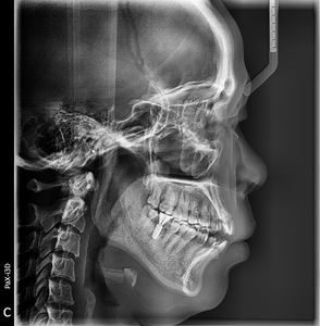 Macchina Radiografica Dentale Pano + Ceph + <span class=keywords><strong>CBCT</strong></span> Best Seller con Simulazione di Movimento dell'Impianto e Istruzioni Vocali - Product Image 4