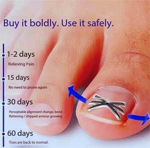 "Kit Corrector de Uñas Encarnadas-Soporte Ajustable de Metal y Silicona para Aliviar el Dolor, Adultos y Niños con Caja de Almacenamiento" - Product Image 3