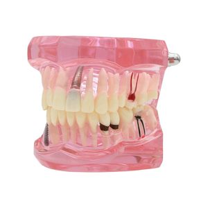 1 modèle dentaire d'étude et de démonstration d'implant dentaire avec restauration, rose - Product Image 1