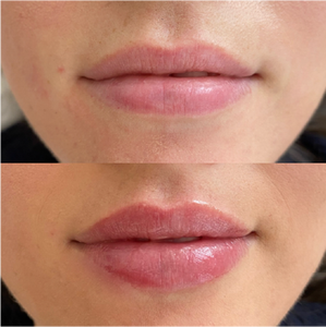 CE Professional Lips Filler 1ml 2ml 3ml 5ml Pure BDDE Cross Linked Hyaluronic Acid Dermal Filler Lip Plump Volume <span class=keywords><strong>Injection</strong></span> - Product Image 6
