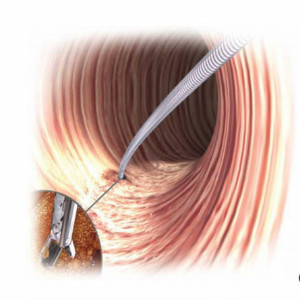 Kẹp Sinh Thiết Cá Sấu Dùng Một Lần 1.8Mm Kẹp Sinh Thiết Linh Hoạt Kẹp Phế Quản Forcpes - Product Image 6